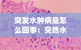 突发水肿病是怎么回事：突然水肿的原因分析 
