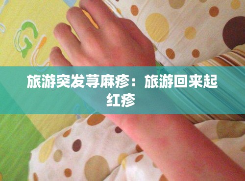 旅游突发荨麻疹：旅游回来起红疹 
