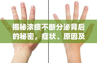揭秘浓痰不断分泌背后的秘密，症状、原因及有效治疗方法！